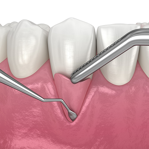 Bone-and-Gum-Suegery